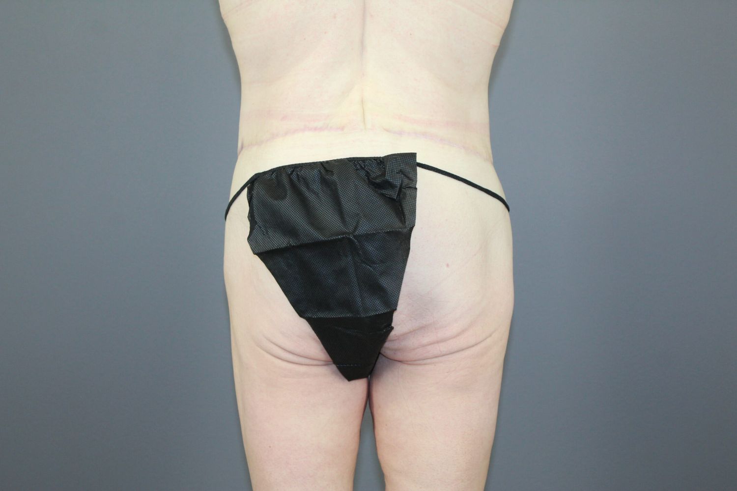 Surgery After Weight Loss Before & After