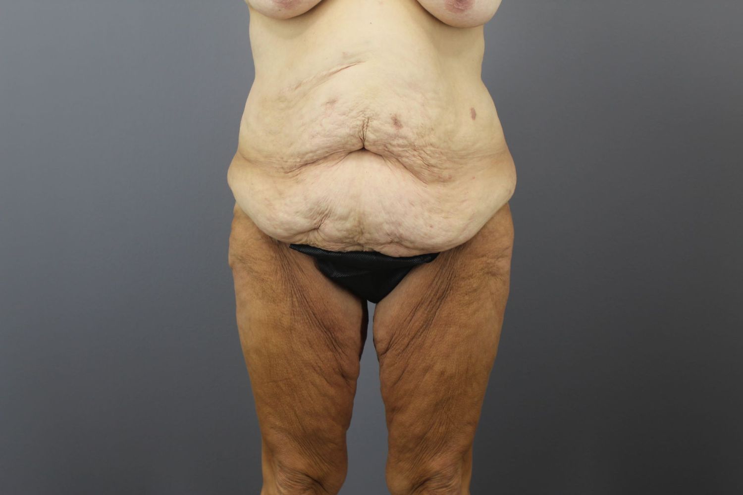 Surgery After Weight Loss Before & After