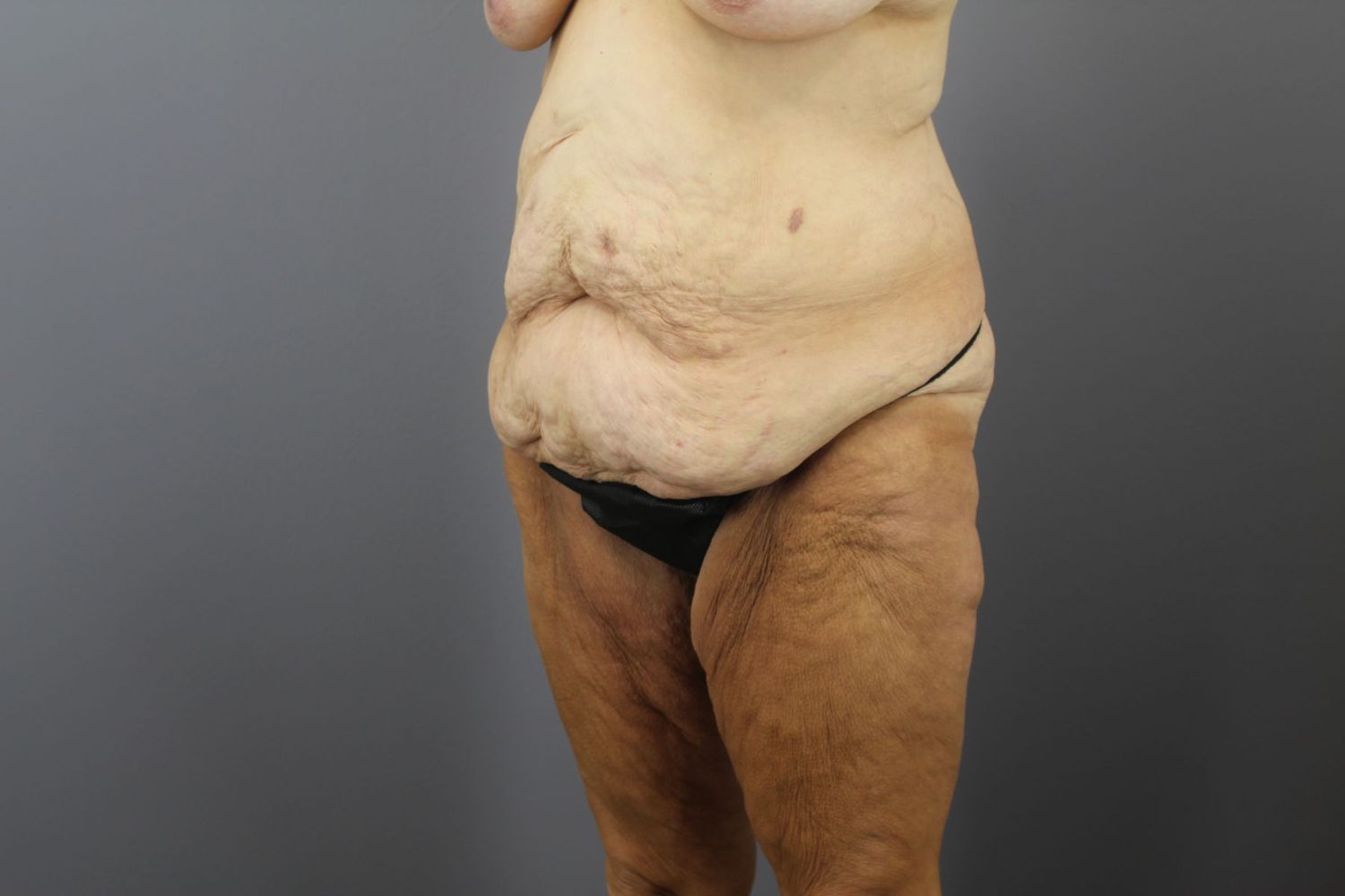 Surgery After Weight Loss Before & After