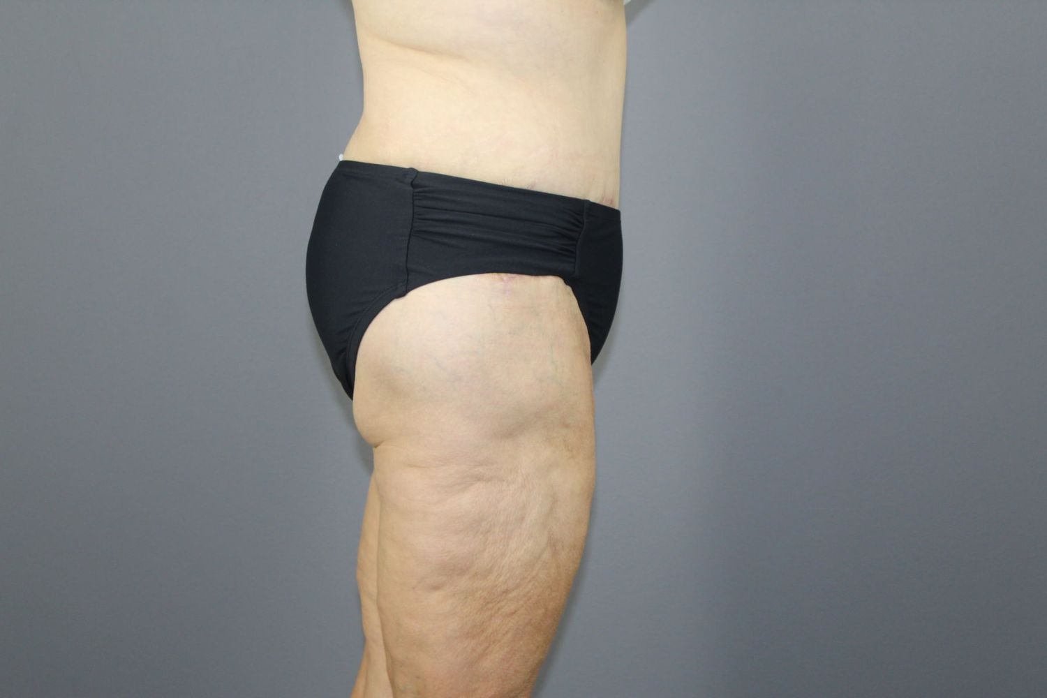 Surgery After Weight Loss Before & After