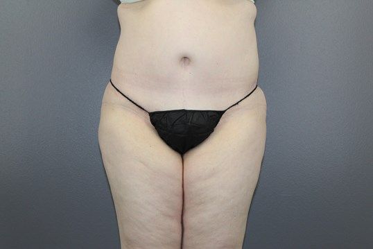 Surgery After Weight Loss Before & After