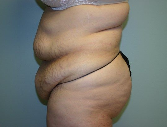 Surgery After Weight Loss Before & After