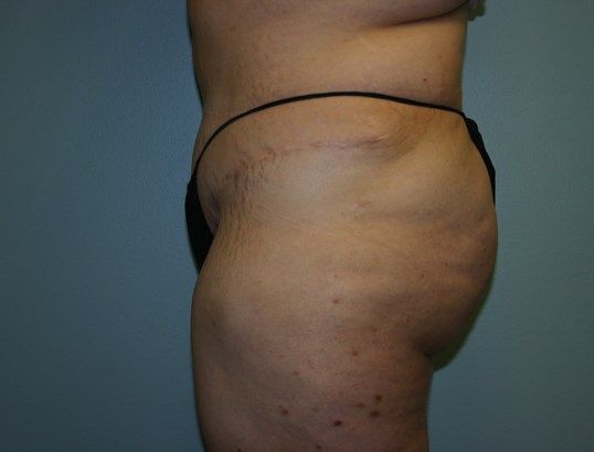Surgery After Weight Loss Before & After