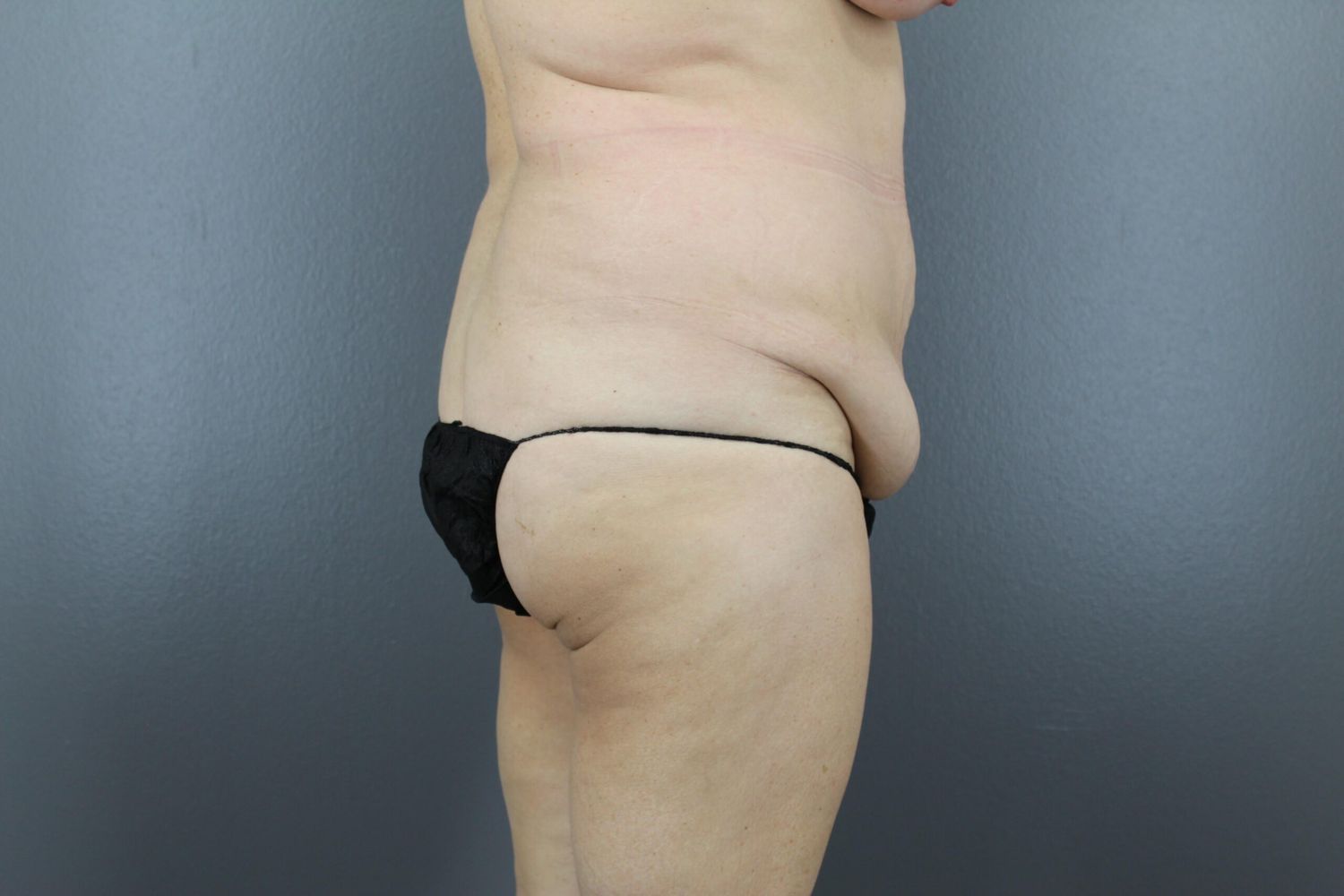 Surgery After Weight Loss Before & After