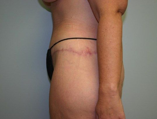 Surgery After Weight Loss Before & After