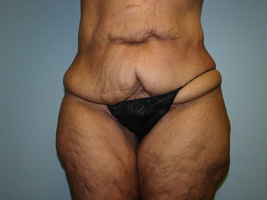 Surgery After Weight Loss Before & After