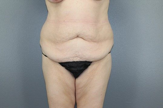 Surgery After Weight Loss Before & After