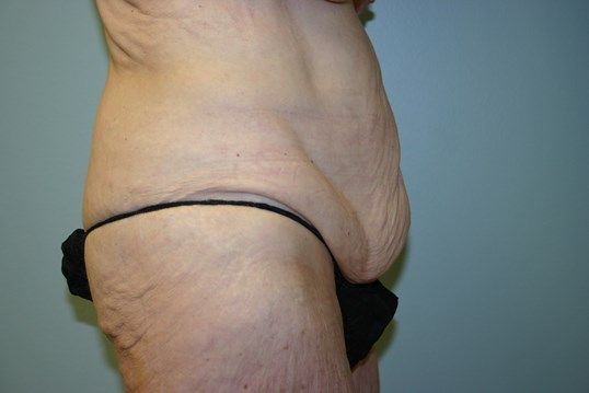 Surgery After Weight Loss Before & After