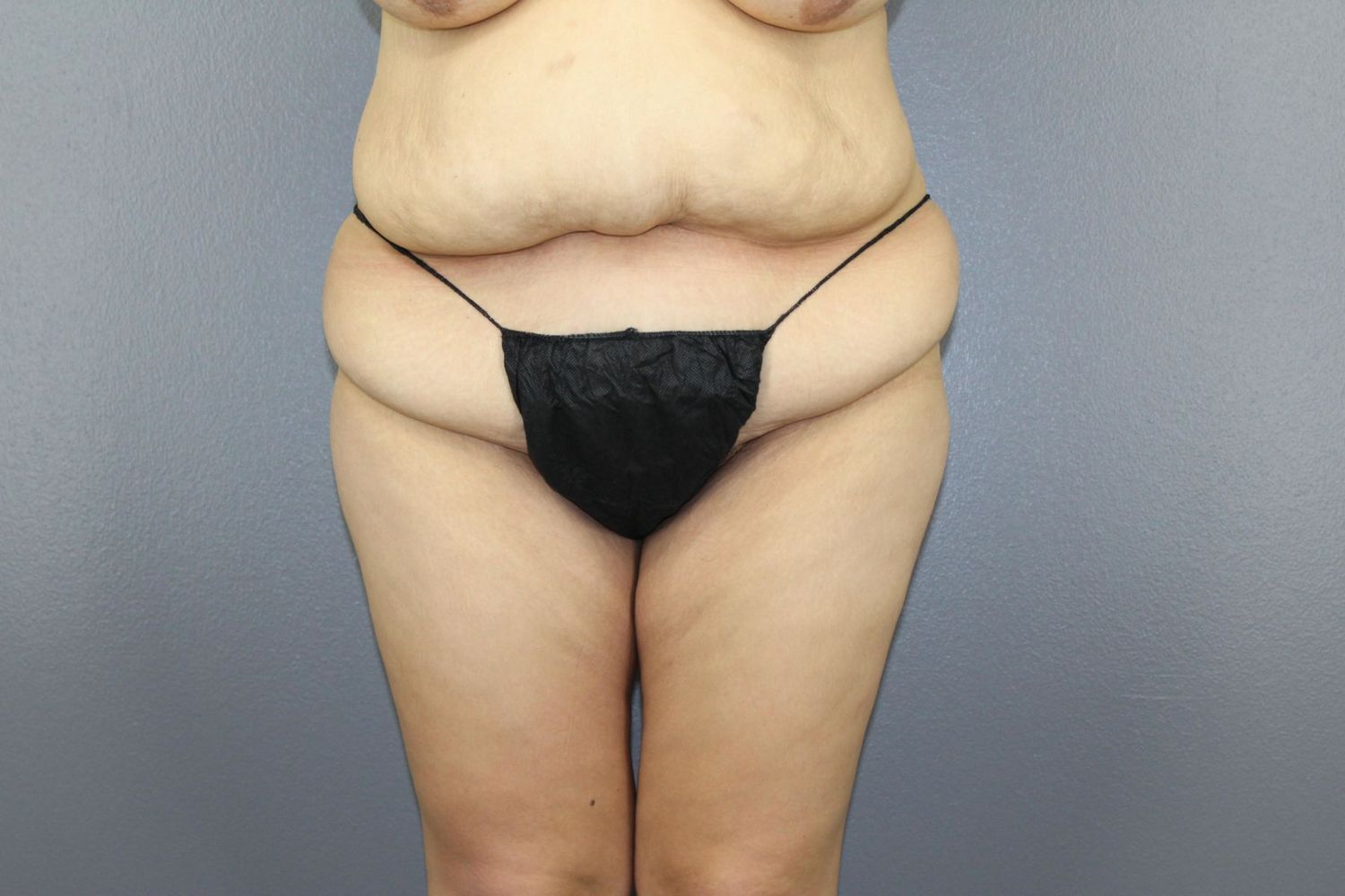 Surgery After Weight Loss Before & After
