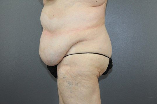 Surgery After Weight Loss Before & After