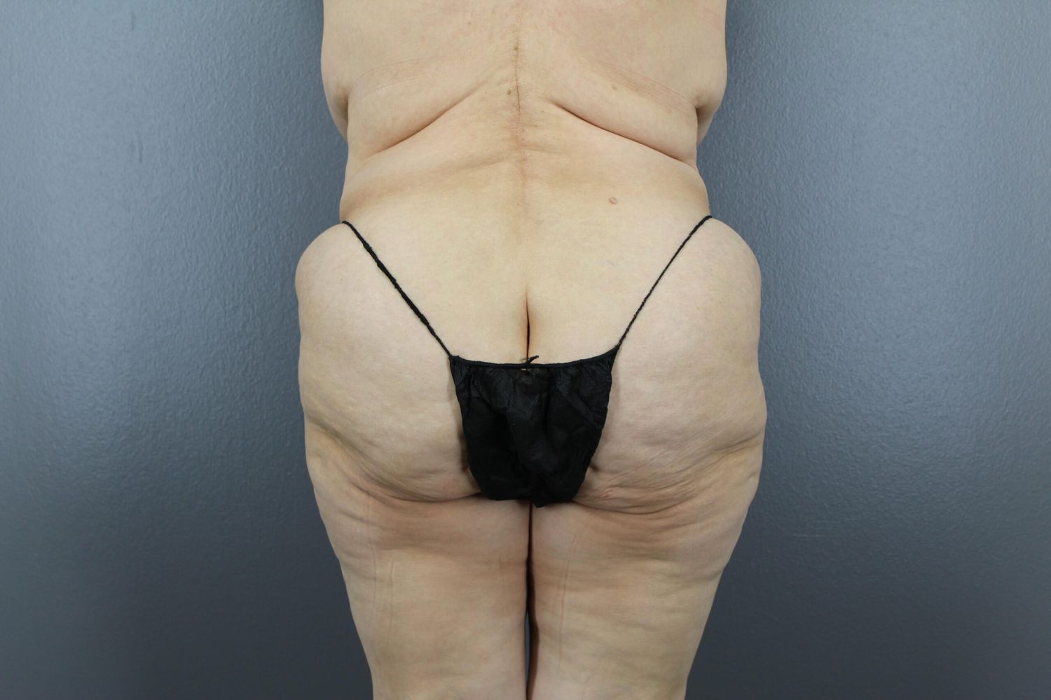 Surgery After Weight Loss Before & After