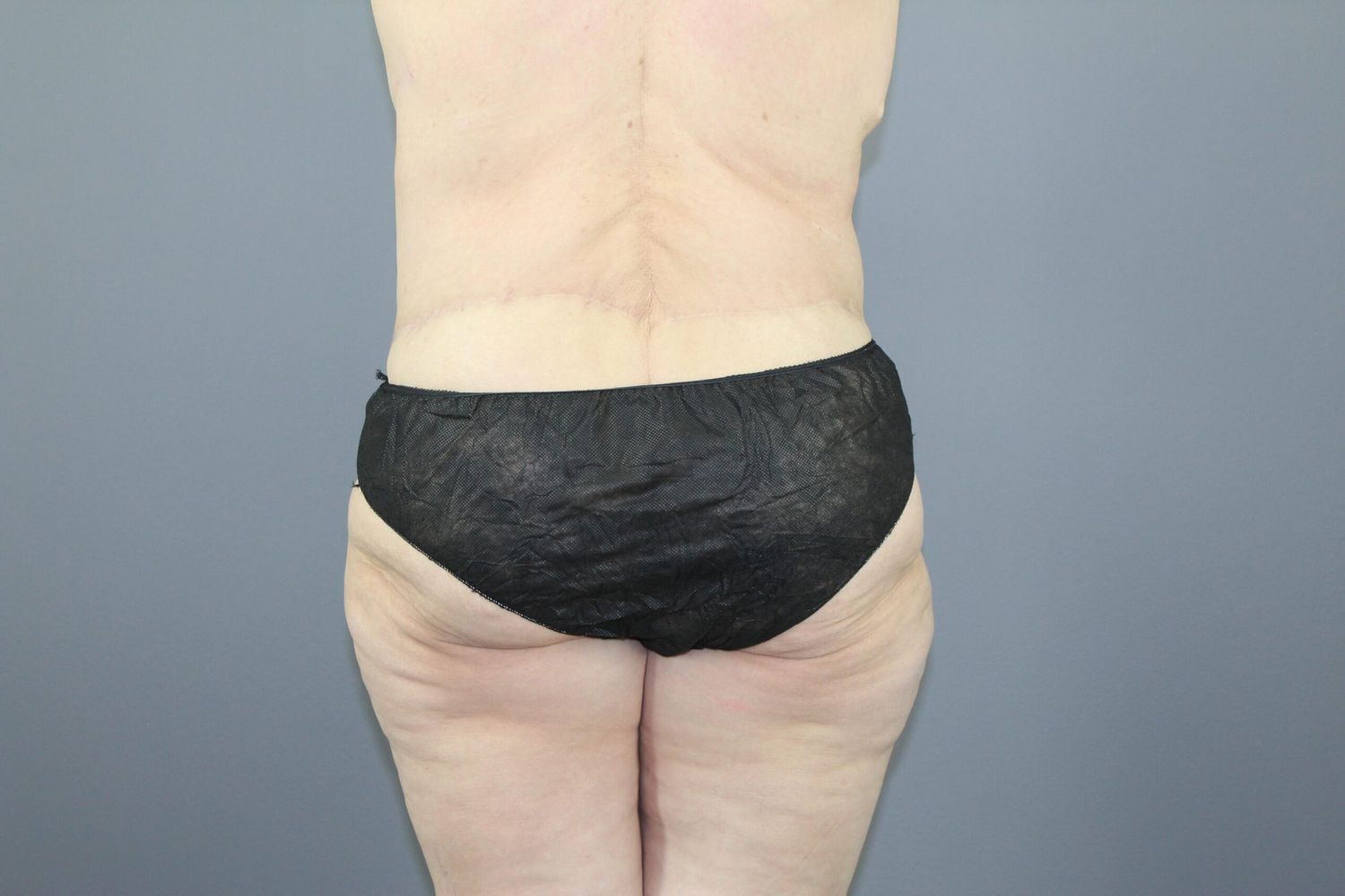 Surgery After Weight Loss Before & After