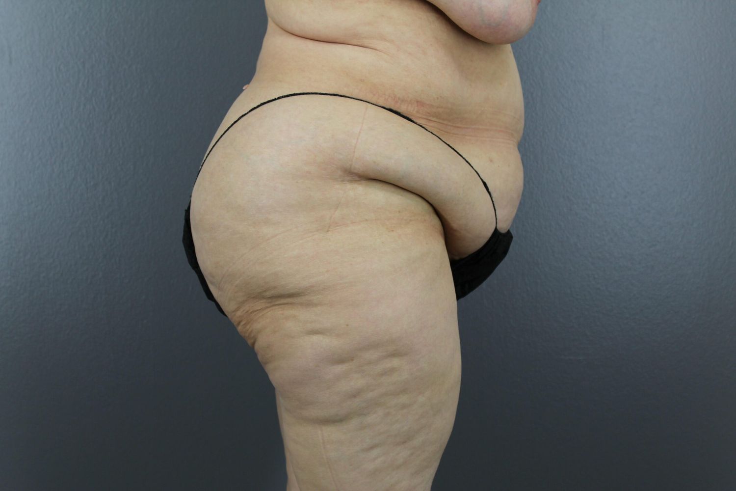 Surgery After Weight Loss Before & After