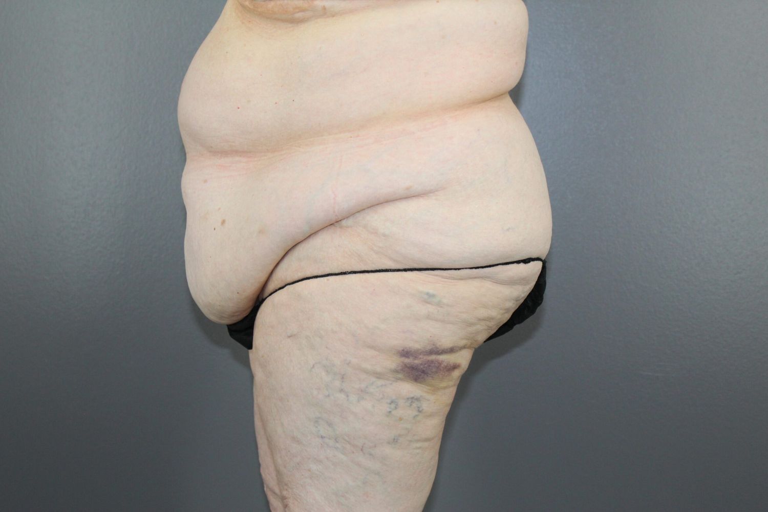 Surgery After Weight Loss Before & After